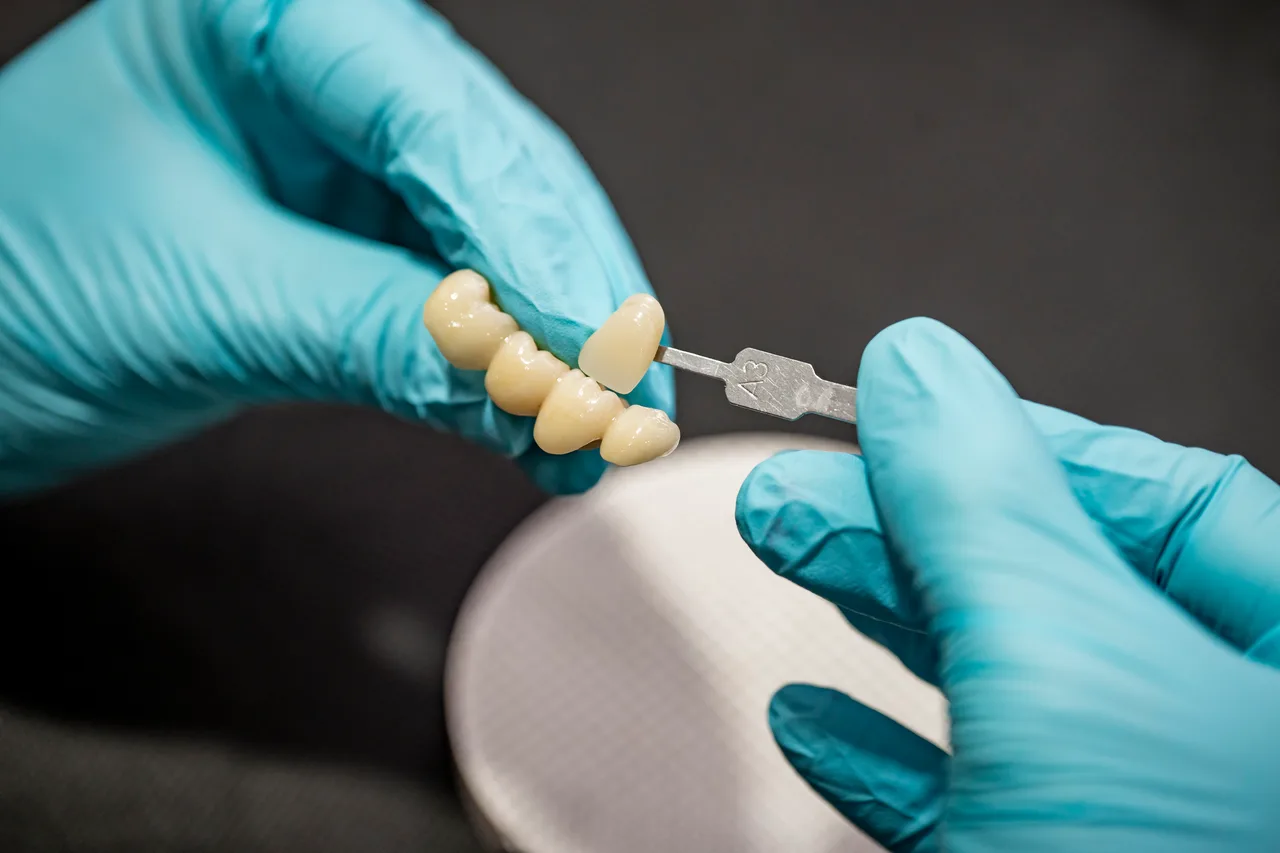 Puente dental de cerámica sostenido con pinzas en el laboratorio de Klida