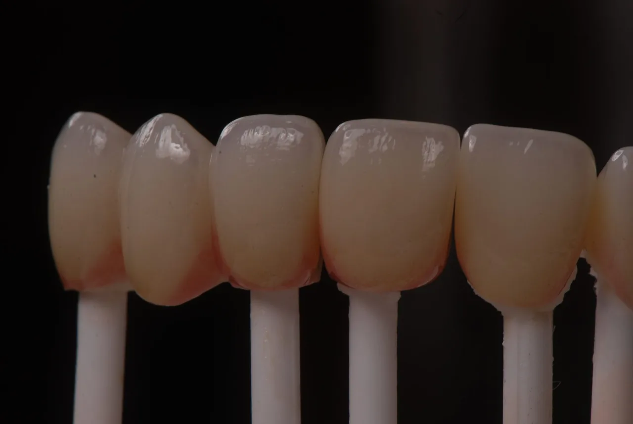 Carillas de cerámica montadas sobre sus muñones