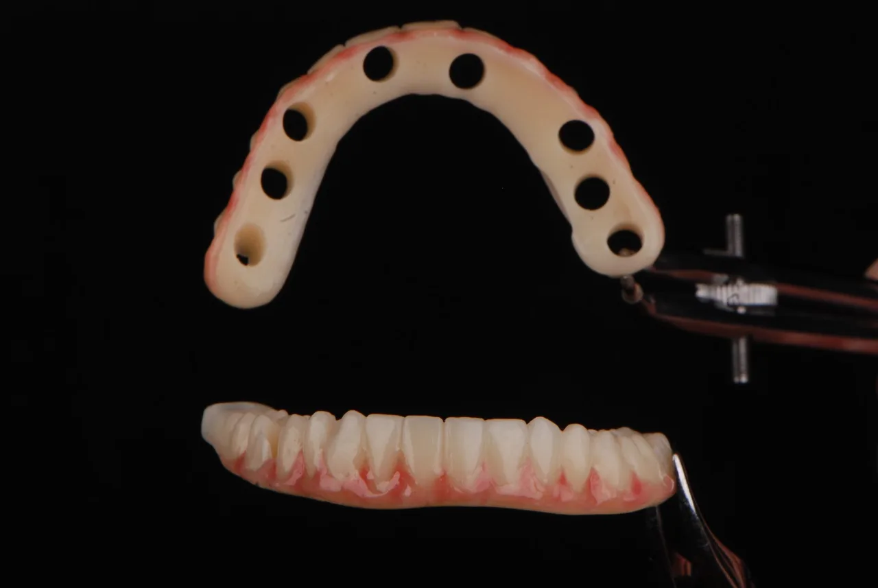 Estructura y prótesis para colocar sobre implantes