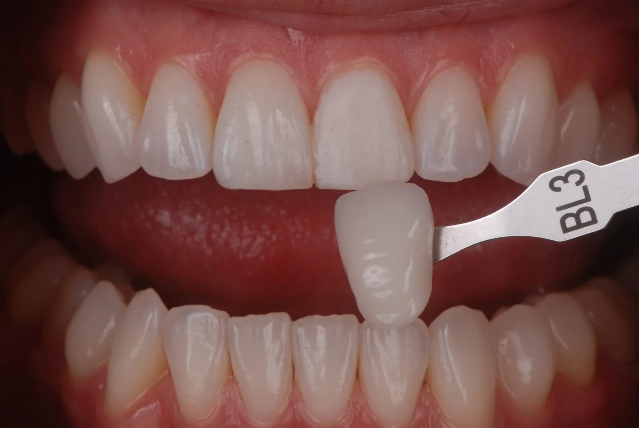 Toma de color BL3 con una guía sobre los dientes de un paciente