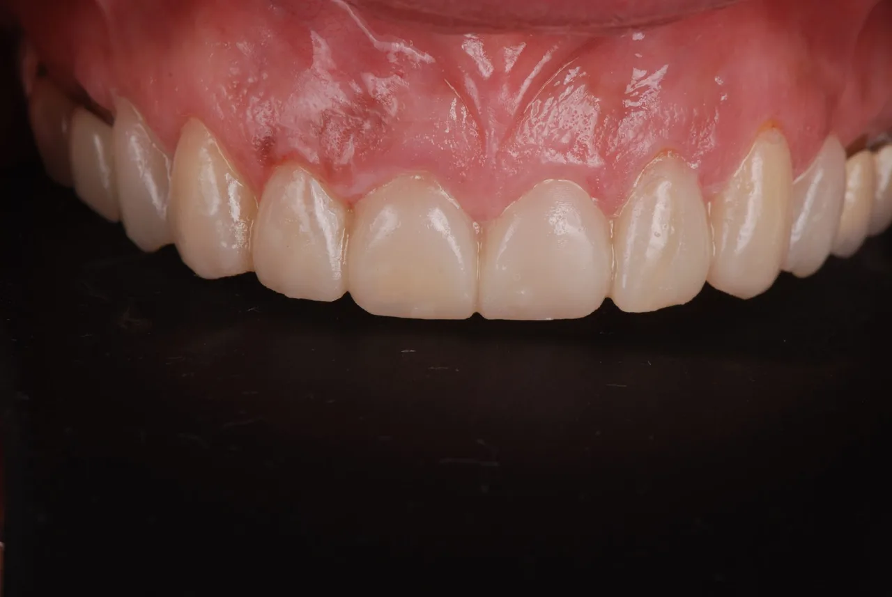 Prueba de la sonrisa diseñada, dientes superiores de frente sobre fondo negro